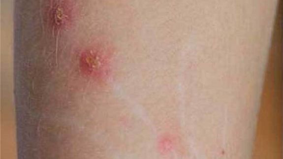 Cat Scratch Disease Cat Scratch Disease