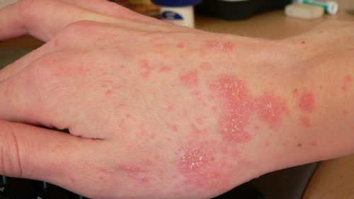 Scabies Scabies on hand