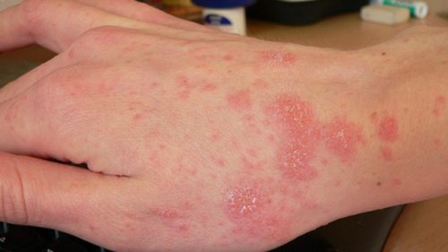 Scabies on hand